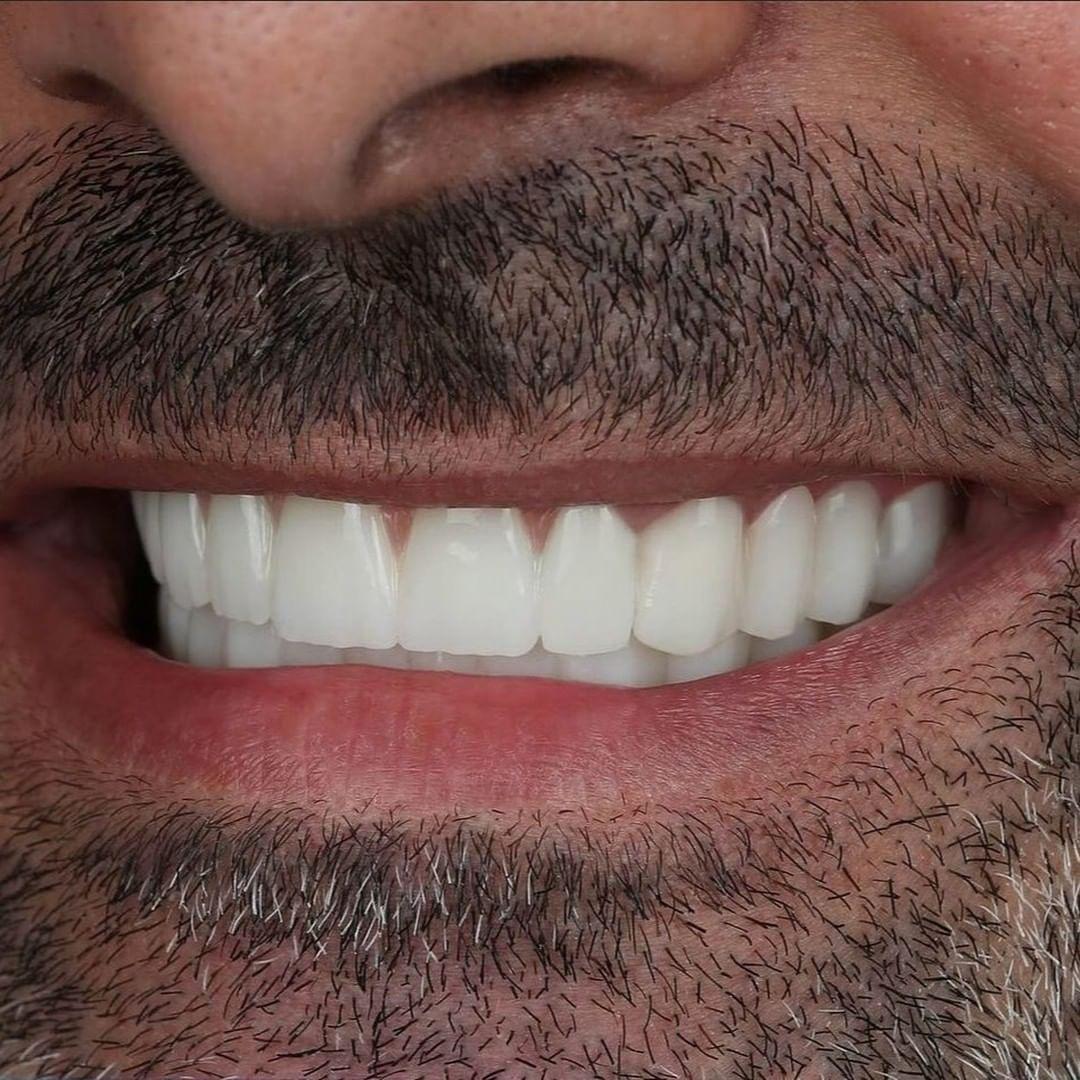 facingturkije-redent-2.jpg facingturkije-redent-2.jpg