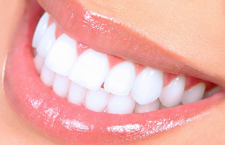 hollywood smile design in turkije