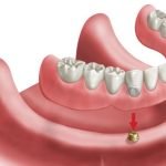 overdentures