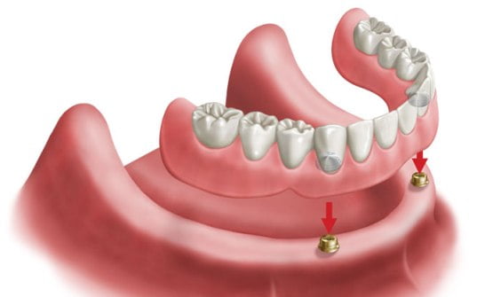 overdentures